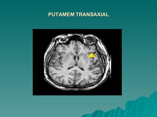 PUTAMEM TRANSAXIAL 