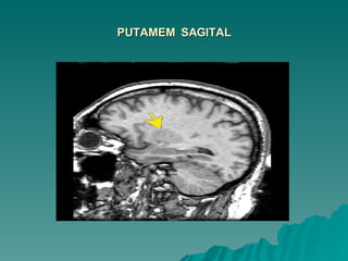 PUTAMEM  SAGITAL 