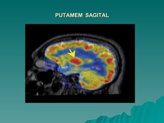 PUTAMEM  SAGITAL 