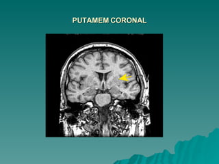 PUTAMEM CORONAL 