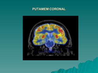 PUTAMEM CORONAL 