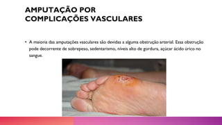 AMPUTAÇÃO POR
COMPLICAÇÕES VASCULARES
• A maioria das amputações vasculares são devidas a alguma obstrução arterial. Essa obstrução
pode decorrente de sobrepeso, sedentarismo, níveis alto de gordura, açúcar ácido úrico no
sangue.
 