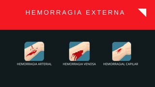 H E M O R R A G I A E X T E R N A
HEMORRAGIA ARTERIAL HEMORRAGIA VENOSA HEMORRAGIAL CAPILAR
 