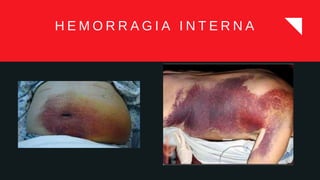 H E M O R R A G I A I N T E R N A
 