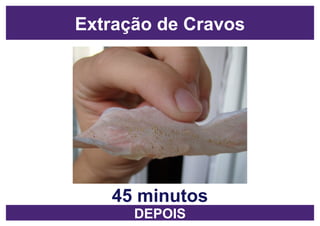 45 minutos DEPOIS Extração de Cravos 