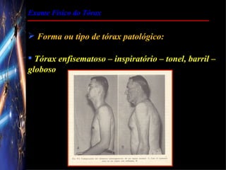 Exame Físico do Tórax


 Forma ou tipo de tórax patológico:

 Tórax enfisematoso – inspiratório – tonel, barril –
globoso
 