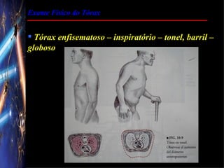 Exame Físico do Tórax


 Tórax enfisematoso – inspiratório – tonel, barril –
globoso
 