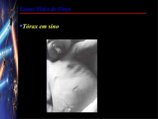 Exame Físico do Tórax


Tórax em sino
 