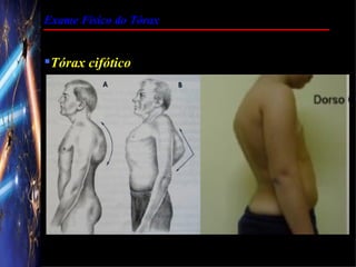 Exame Físico do Tórax


Tórax cifótico
 