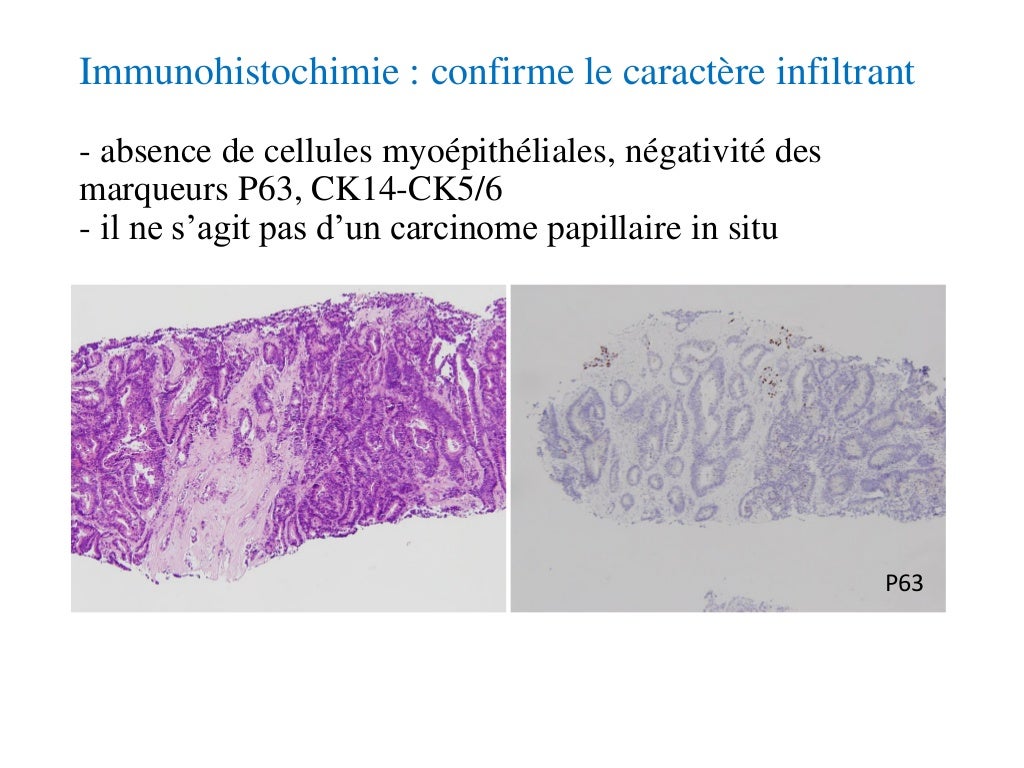 Quelle Différence Entre Un Cancer Invasif Et Infiltrant