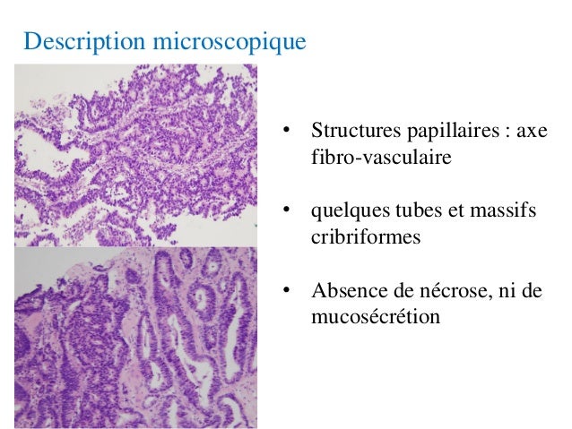 Carcinome Papillaire