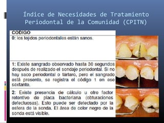 Índice de Necesidades de Tratamiento
Periodontal de la Comunidad (CPITN)
 