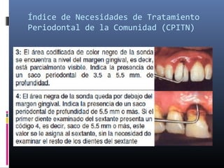 Índice de Necesidades de Tratamiento
Periodontal de la Comunidad (CPITN)
 