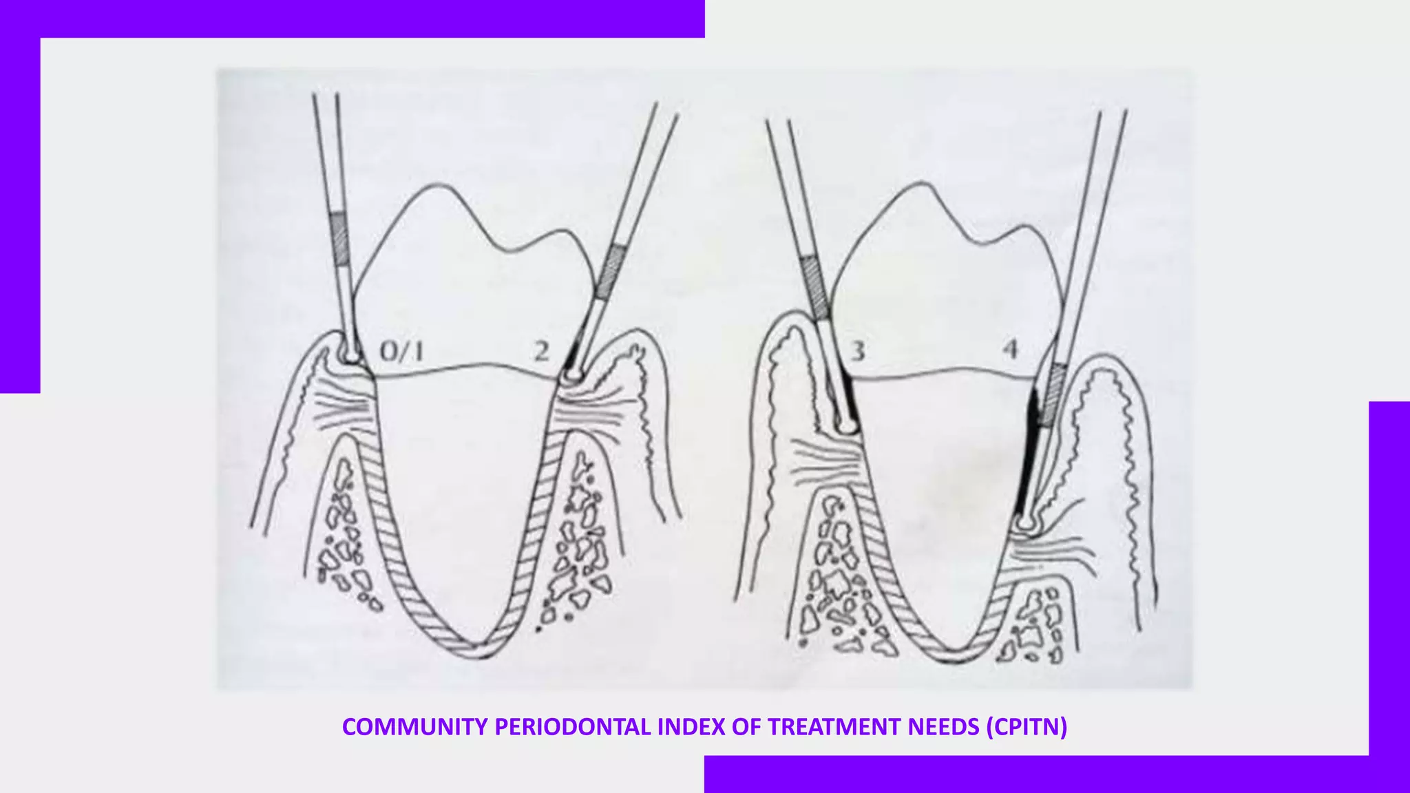 COMMUNITY PERIODONTAL INDEX OF TREATMENT NEEDS (CPITN)
 