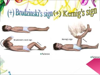 (+) Brudzinski's sign (+) Kernig's sign 