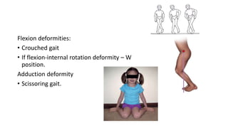 Flexion deformities:
• Crouched gait
• If flexion-internal rotation deformity – W
position.
Adduction deformity
• Scissoring gait.
 