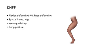 KNEE
• Flexion deformity ( MC knee deformity)
• Spastic hamstrings
• Weak quadriceps.
• Jump posture.
 