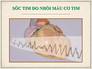 SỐC TIM DO NHỒI MÁU CƠ TIM
 