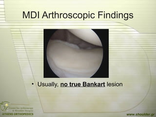 MDI Arthroscopic Findings
• Usually, no true Bankart lesion
www.shoulder.gr
 