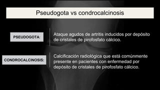 Condrocalcinosis.pptx