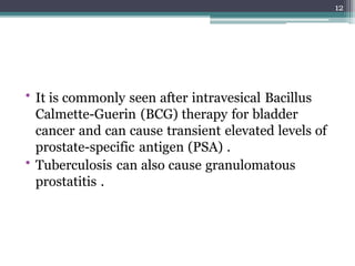 • It is commonly seen after intravesical Bacillus
Calmette-Guerin (BCG) therapy for bladder
cancer and can cause transient elevated levels of
prostate-specific antigen (PSA) .
• Tuberculosis can also cause granulomatous
prostatitis .
12
 