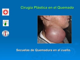 Cirugía Plástica en el Quemado Secuelas de Quemadura en el cuello. 