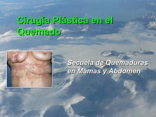 Cirugía Plástica en el Quemado Secuela de Quemaduras en Mamas y Abdomen 