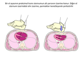 Bir el ayasının proksimal kısmı sternumun alt yarısının üzerine konur. Diğer el
sternum üzerindeki elin üzerine, parmakları kenetleyerek yerlestirilir

 