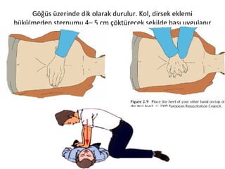 Göğüs üzerinde dik olarak durulur. Kol, dirsek eklemi
bükülmeden sternumu 4– 5 cm çöktürecek şekilde bası uygulanır

 