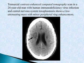 Cerebral Toxoplasmosis