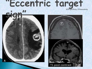 Cerebral Toxoplasmosis