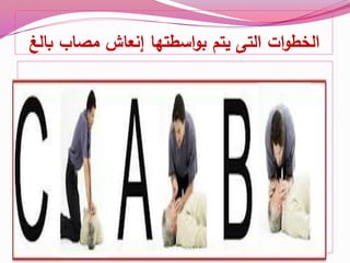 ‫الت‬ ‫ات‬‫و‬‫الخط‬‫ى‬‫يتم‬‫إنعاش‬ ‫اسطتها‬‫و‬‫ب‬‫مصاب‬‫بالغ‬
 