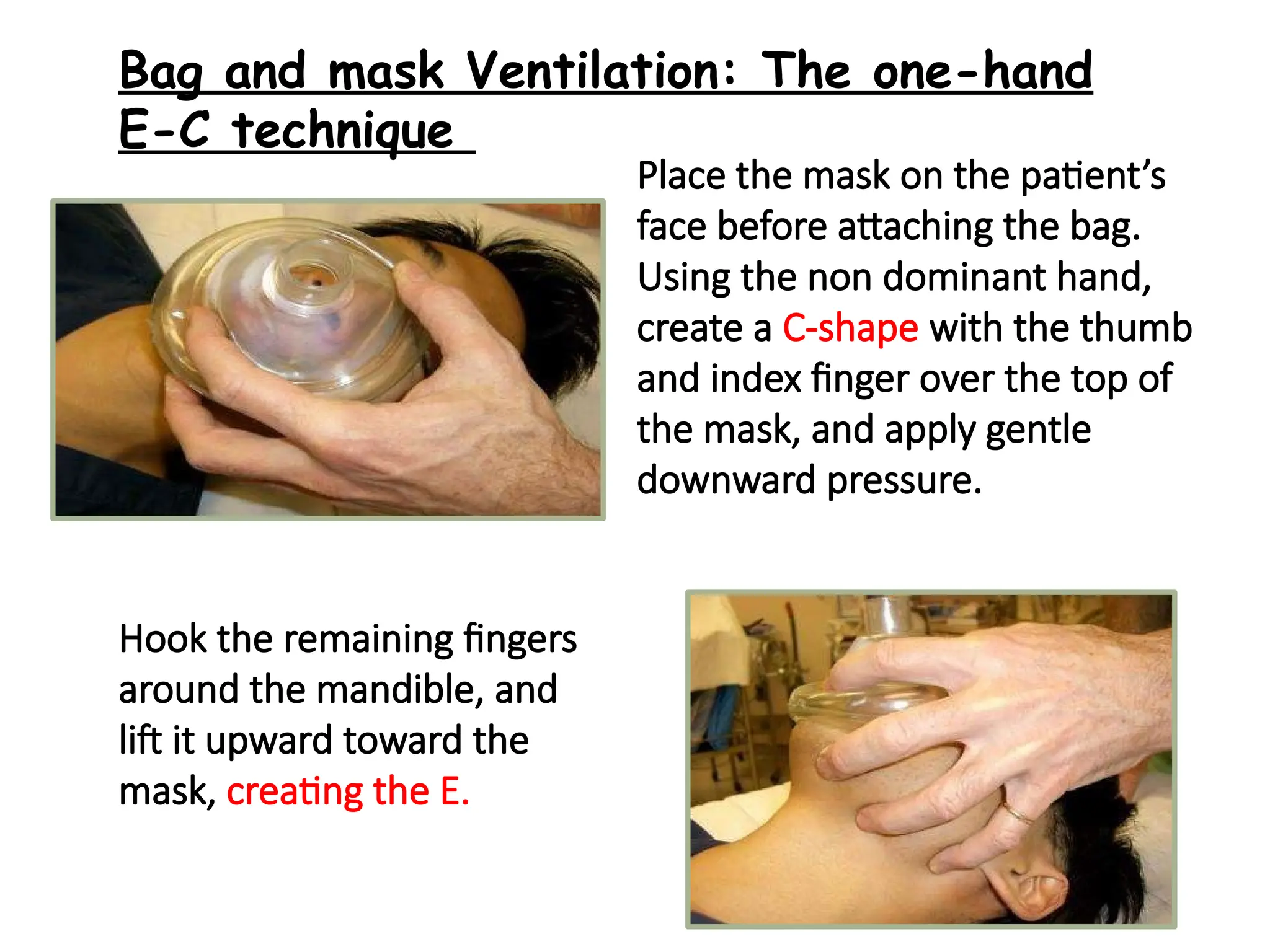 33
Place the mask on the patient’s
face before attaching the bag.
Using the non dominant hand,
create a C-shape with the thumb
and index finger over the top of
the mask, and apply gentle
downward pressure.
Hook the remaining fingers
around the mandible, and
lift it upward toward the
mask, creating the E.
Bag and mask Ventilation: The one-hand
E-C technique
 