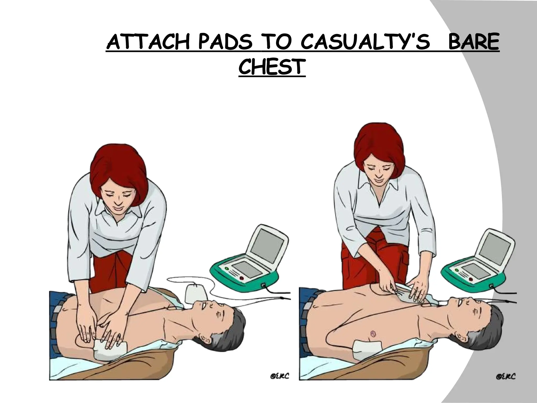 ATTACH PADS TO CASUALTY’S BARE
CHEST
 