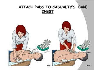 ATTACH PADS TO CASUALTY’S BARE
CHEST
 