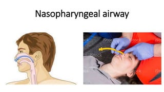 Nasopharyngeal airway
 