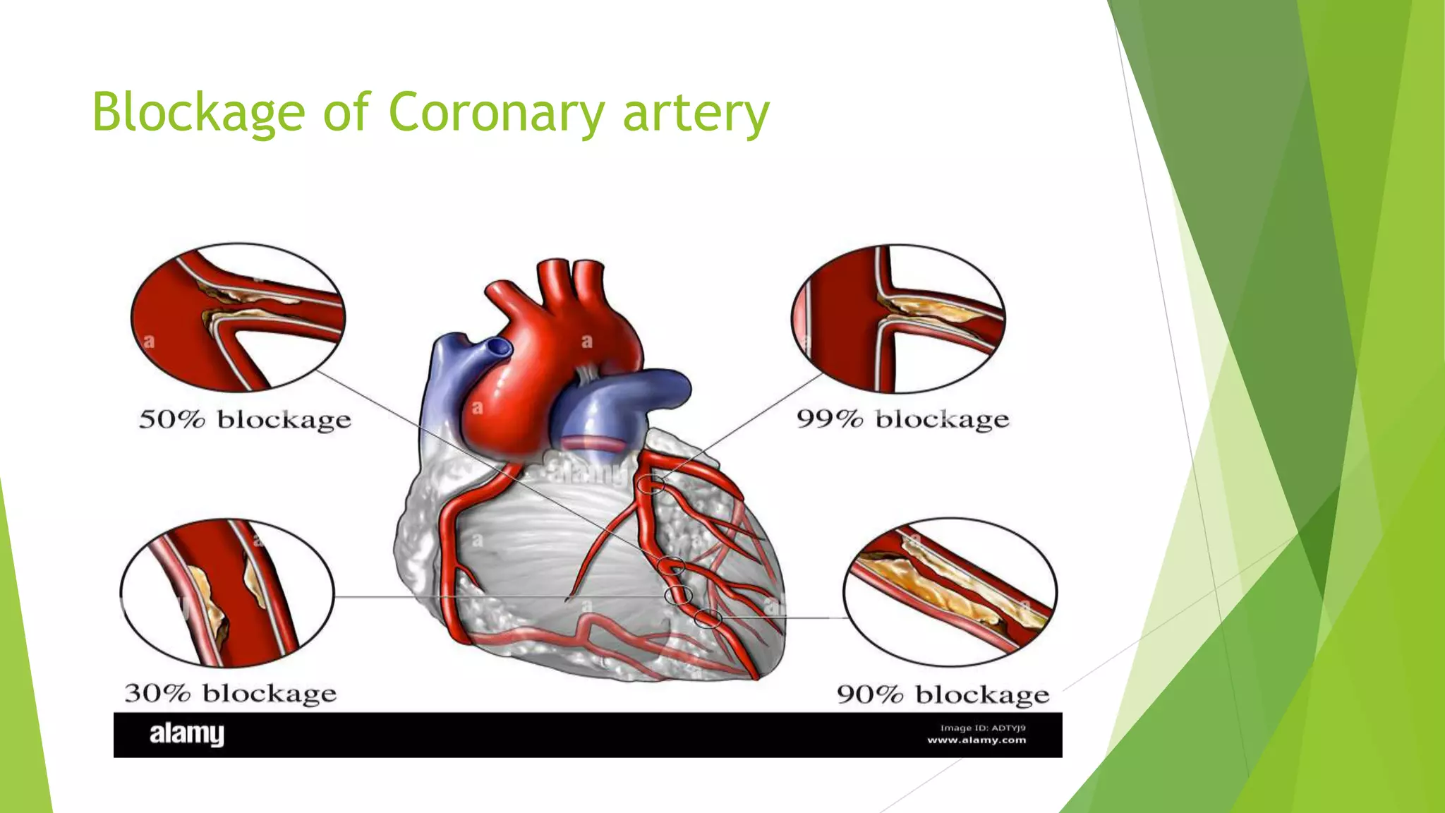Blockage of Coronary artery
 
