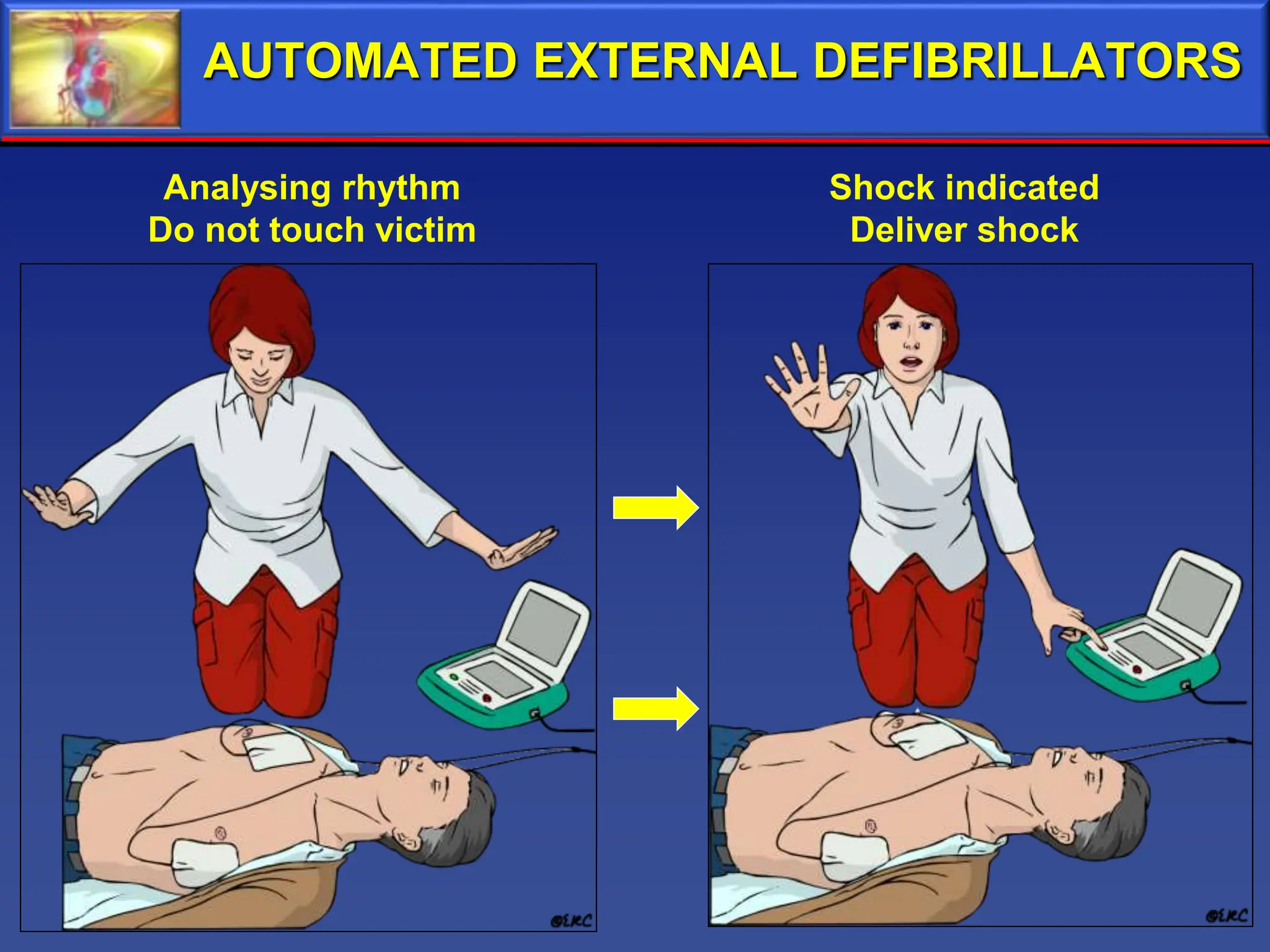 CPR ( Cardio Pulmonary Resuscitation ) skill to save lives in cardiac