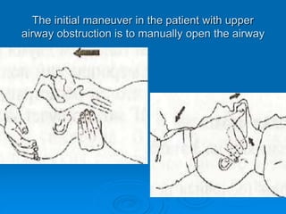 The initial maneuver in the patient with upper
airway obstruction is to manually open the airway
 