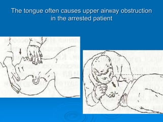 The tongue often causes upper airway obstruction
in the arrested patient
 