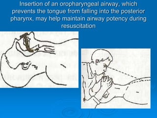 Insertion of an oropharyngeal airway, which
prevents the tongue from falling into the posterior
pharynx, may help maintain airway potency during
resuscitation
 