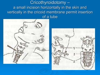 Cricothyroidotomy –
a small incision horizontally in the skin and
vertically in the cricoid membrane permit insertion
of a tube
 