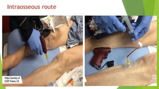Intraosseous route
 