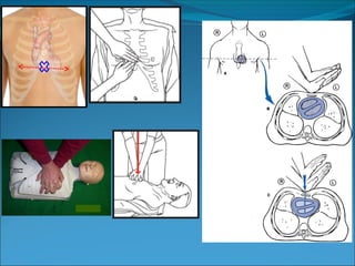 Comprehensive Guide to Cardiopulmonary Resuscitation (CPR) Techniques ...