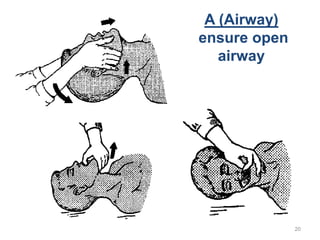 A (Airway)
ensure open
airway

20

 