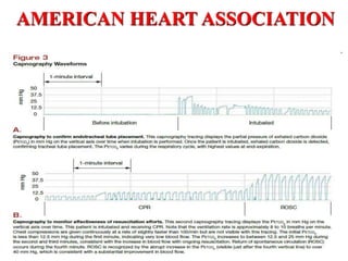 AMERICAN HEART ASSOCIATION
CAPNOGRAPHY
 