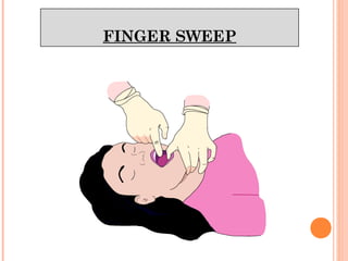 Cpr and fbao | PPT