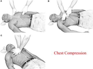Chest Compress CPR( Cardiopulmonary Resuscitation | PPT