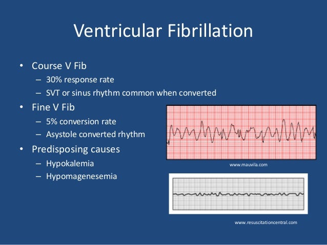 How To Treat Ventricular Fibrillation Dog Drug How To Treat Ventricular Fibrillation Dog Drug