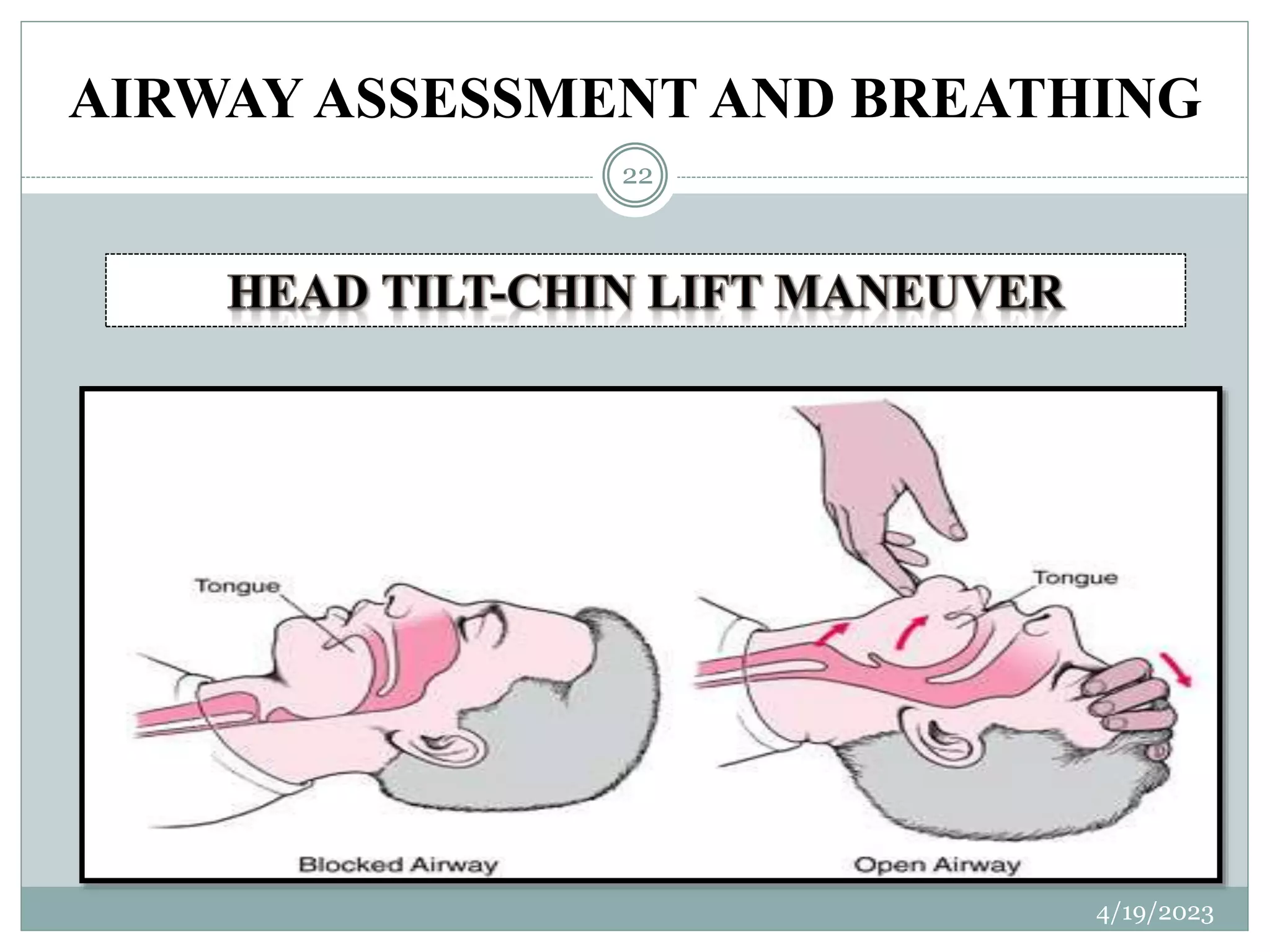 AIRWAY ASSESSMENT AND BREATHING
4/19/2023
22
 